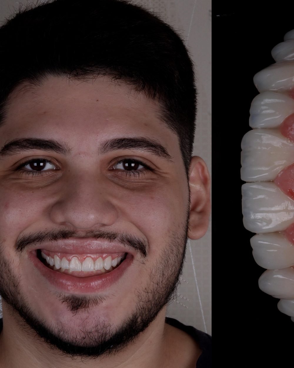 Antes e depois de facetas em resina