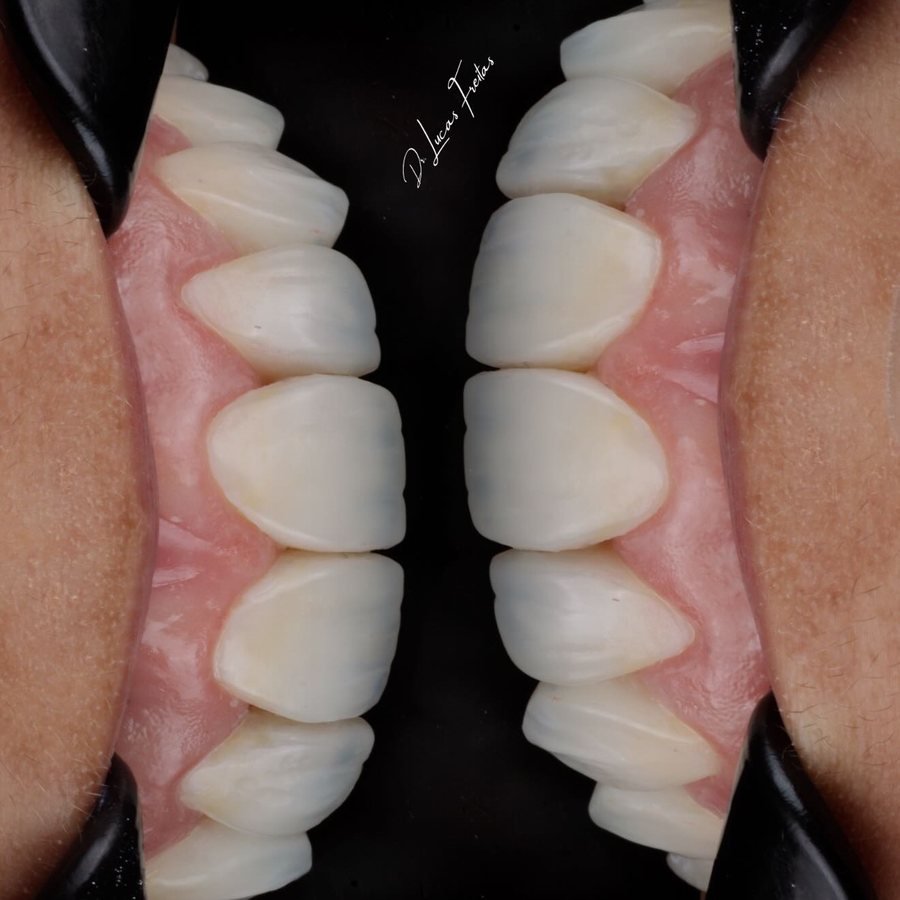 Detalhe de facetas em resina, vista frontal