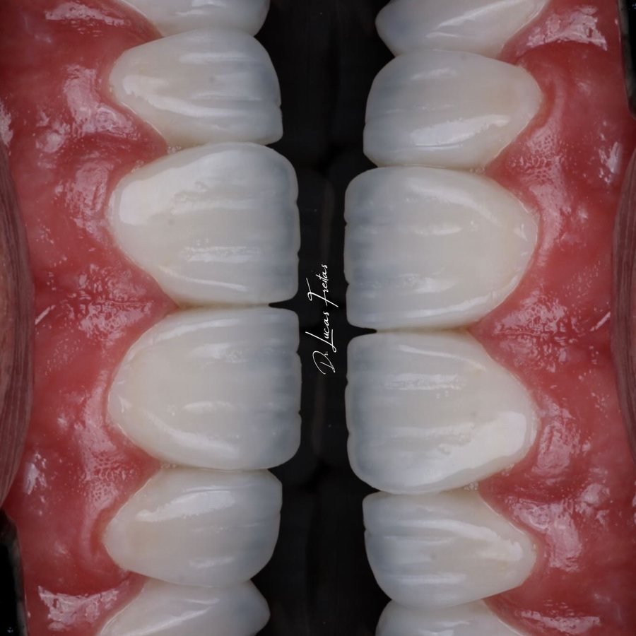 Facetas em resina, close do sorriso