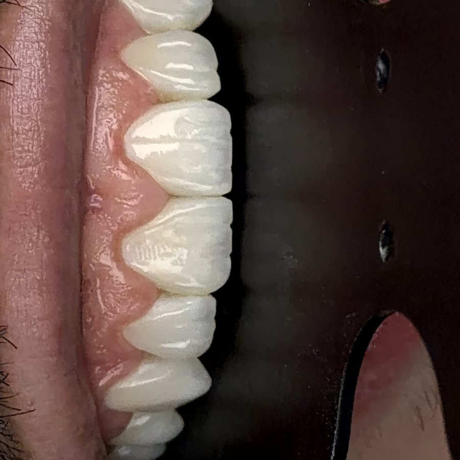Facetas em resina, detalhe da textura