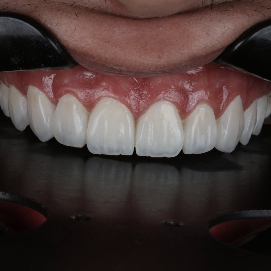 Resultado final das facetas em resina