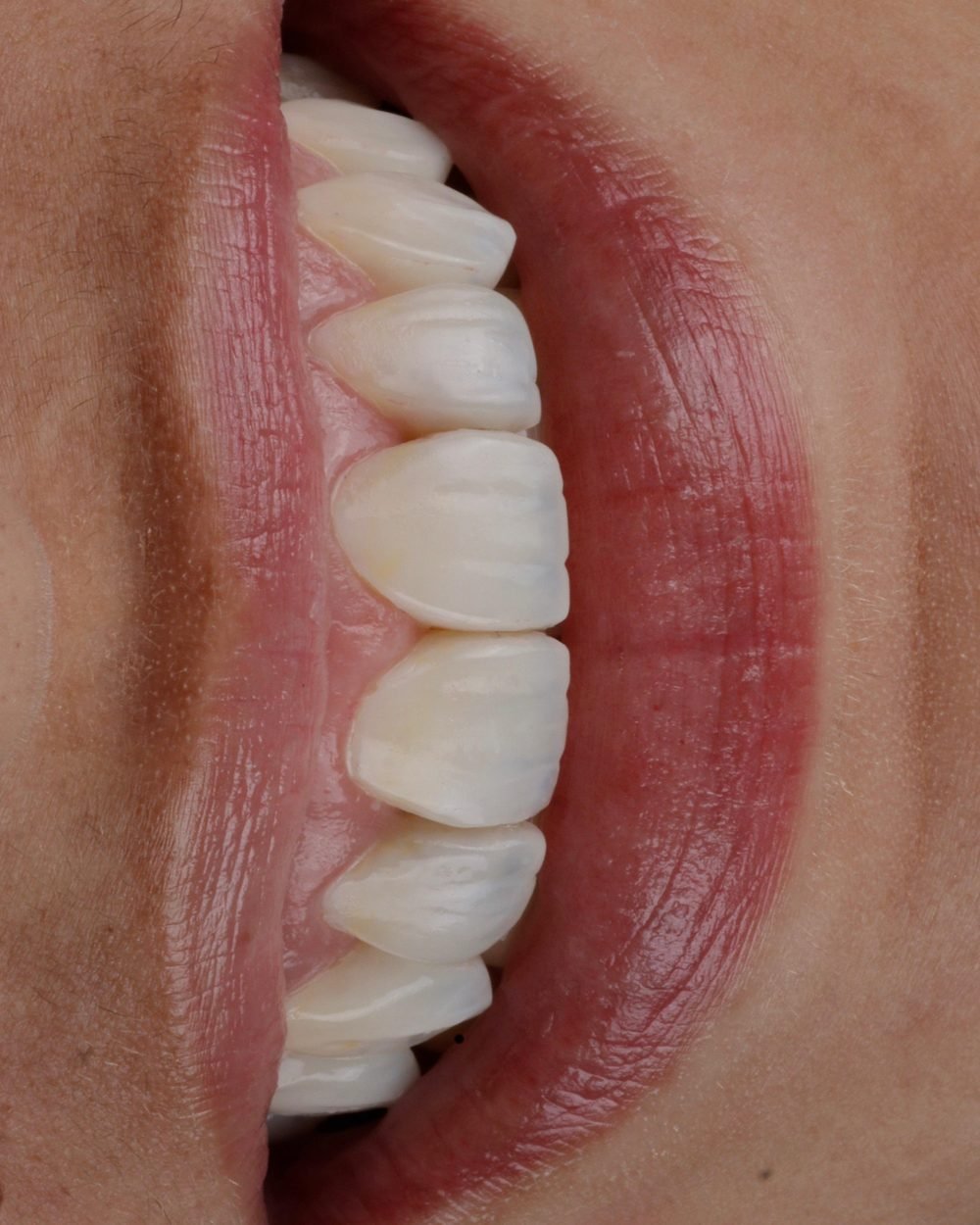 Detalhe da naturalidade das facetas em resina