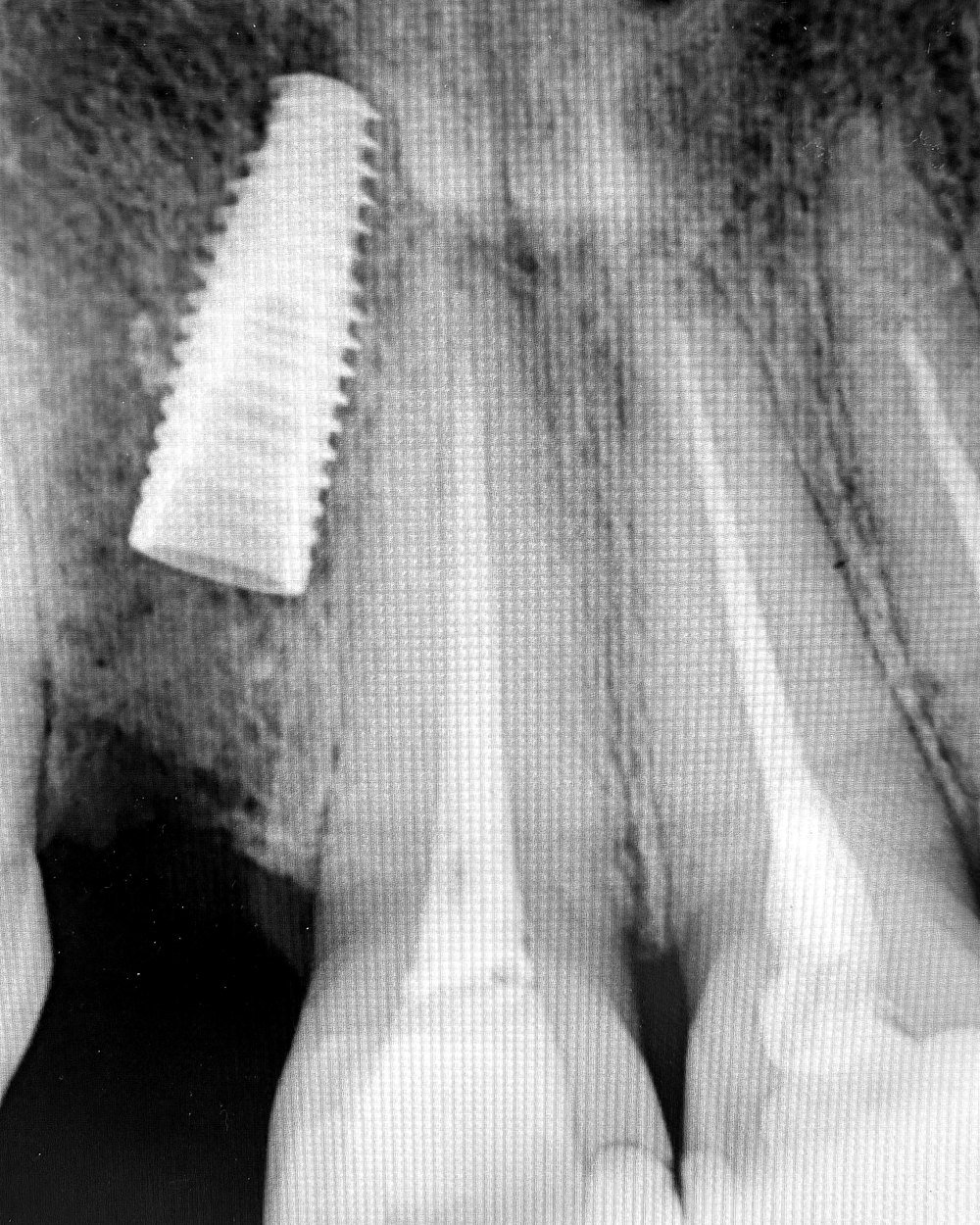Radiografia usada no planejamento de implante dentário