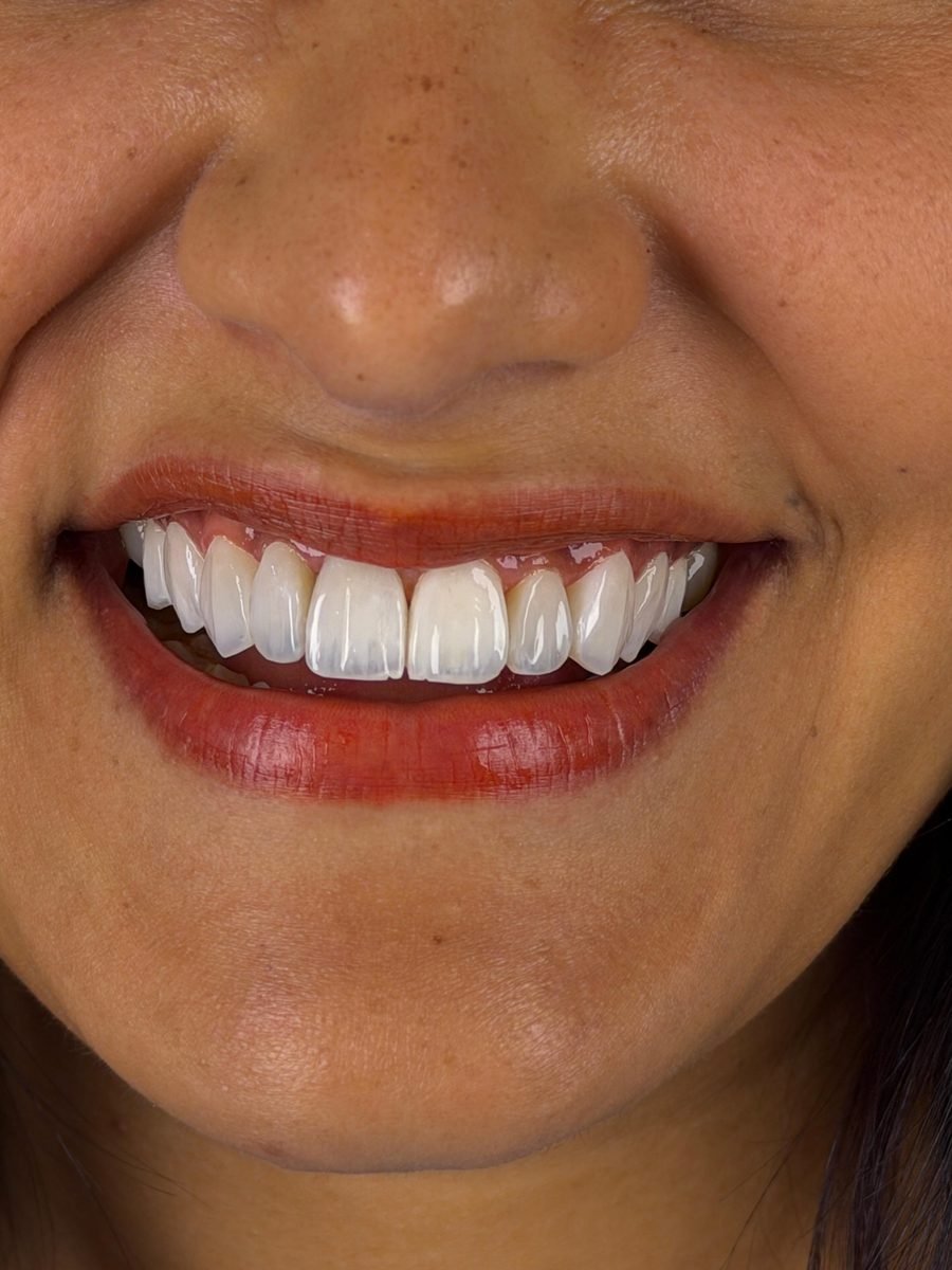 Sorriso de paciente após facetas em resina